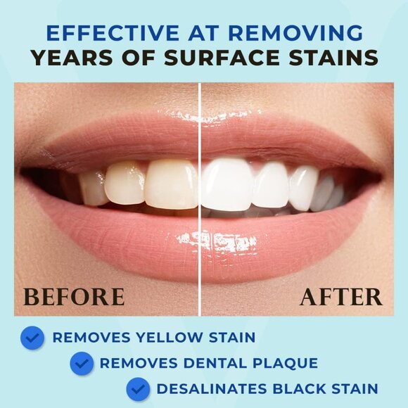 Award Winning Teeth Whitening Pen, 20+ Uses - Teeth whitening Kit Professionally - Picture 2 of 9